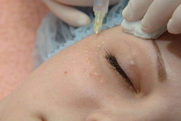 Mesoterapia - un método de inxección para rexuvenecer a pel da cara