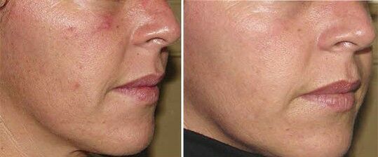 Cara antes e despois do rexuvenecemento da pel